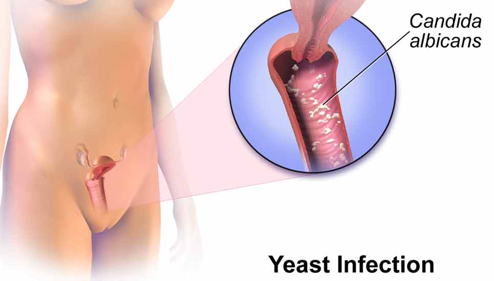 can sperm cause yeast infection