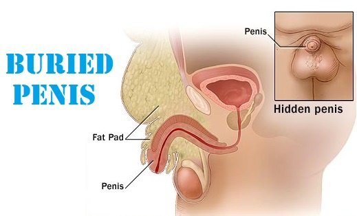 does losing weight make your penis bigger