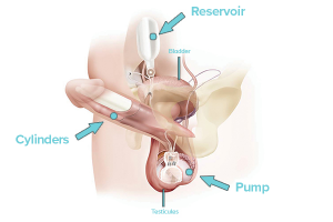 how does a penile implant work