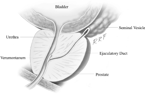 how to cure a blocked sperm duct naturally