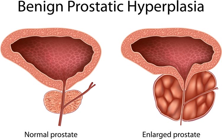 what causes enlarged prostate