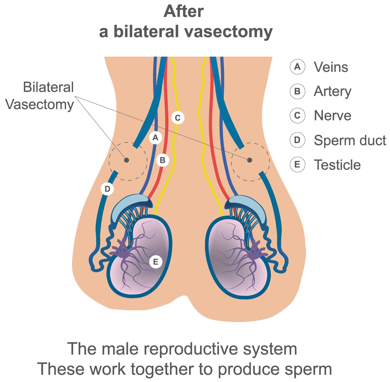 what happens to sperm after vasectomy