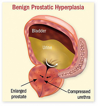 what is the best treatment for enlarged prostate